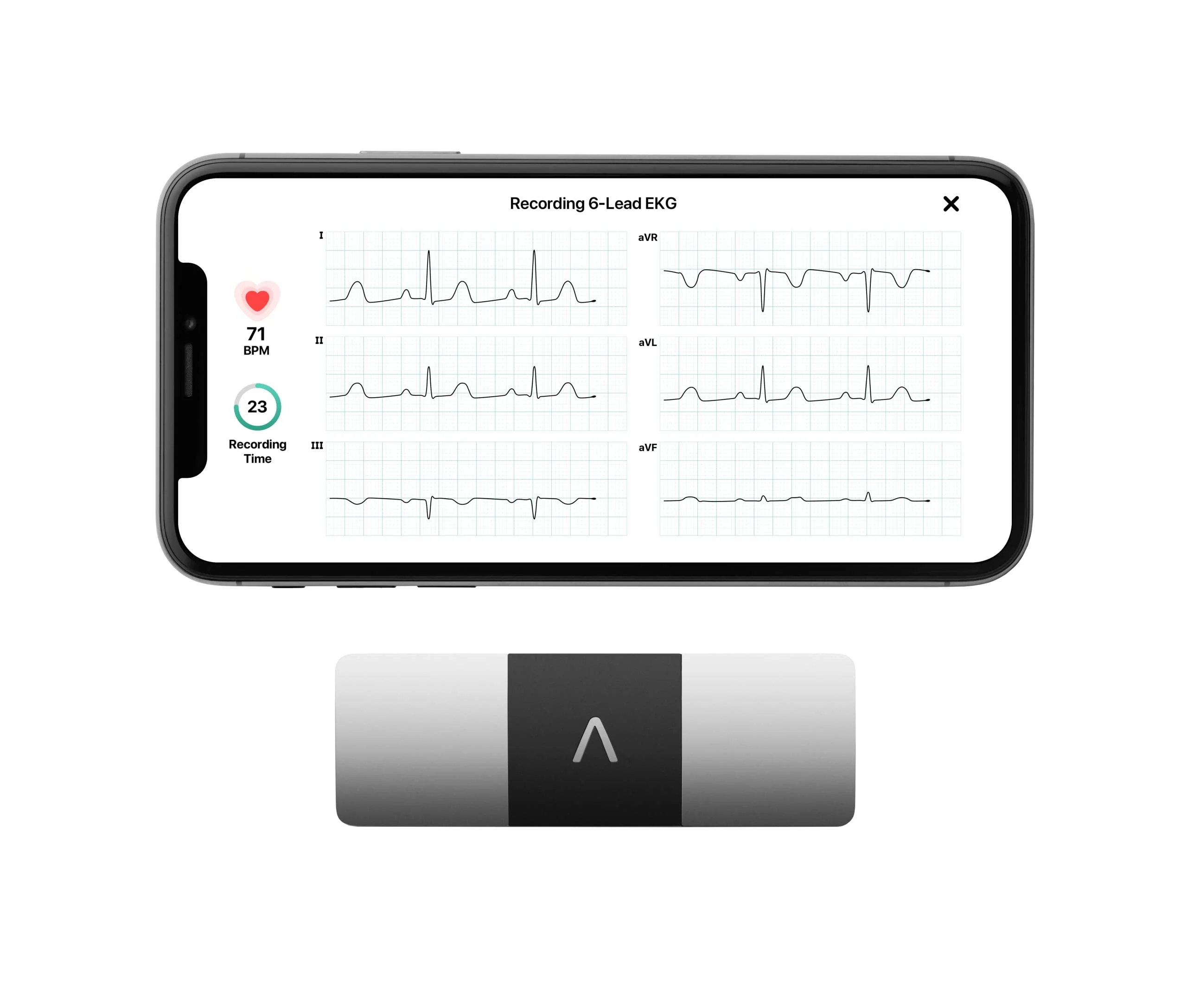 AliveCor KardiaMobile 6L Personal EKG Monitor, FDA-Cleared, Six-Lead, Smartphone Compatible, Detects AFib, Bradycardia, Tachycardia